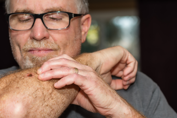 Skin Check - Southport Doctors Gold Coast